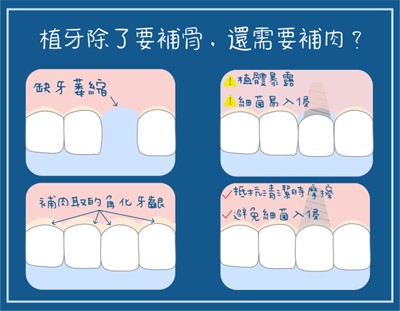 【植牙可能不只要補骨,還要補肉?】 【植牙可能不只要補骨,還要補肉?】