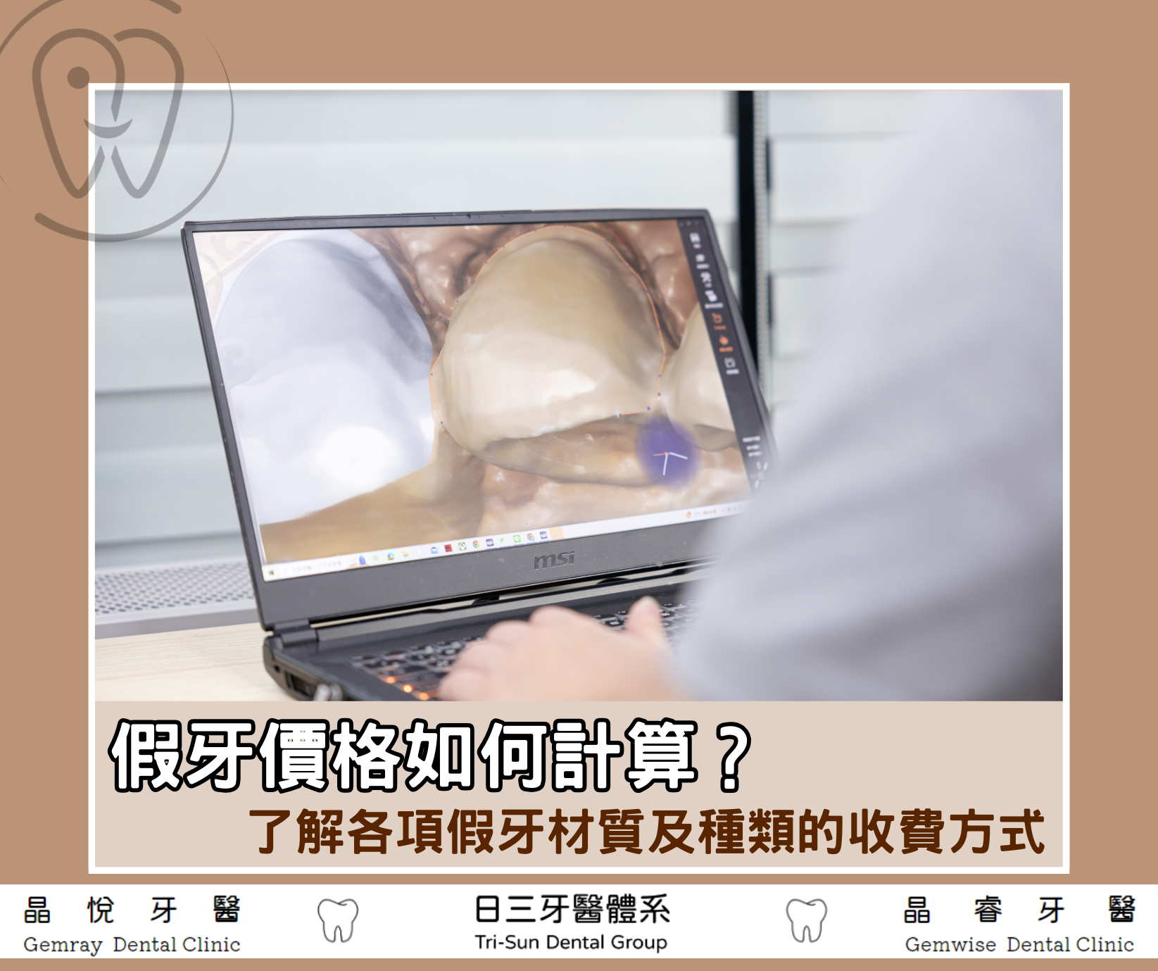 2025三大假牙價格比較表！從假牙材質、價格影響因素一次懂