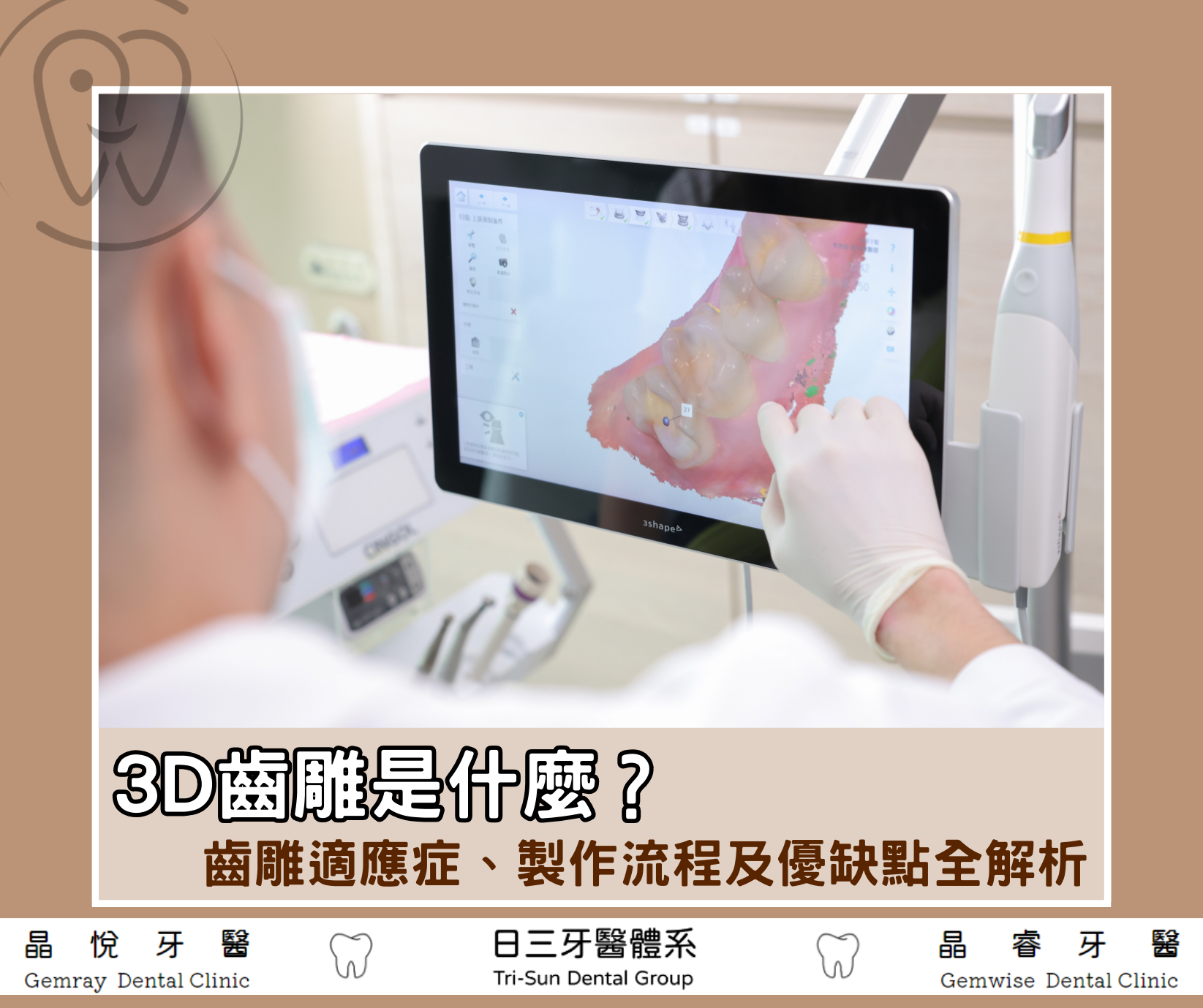 3D齒雕是什麼？種類、優缺點、價格、療程、壽命全解析！