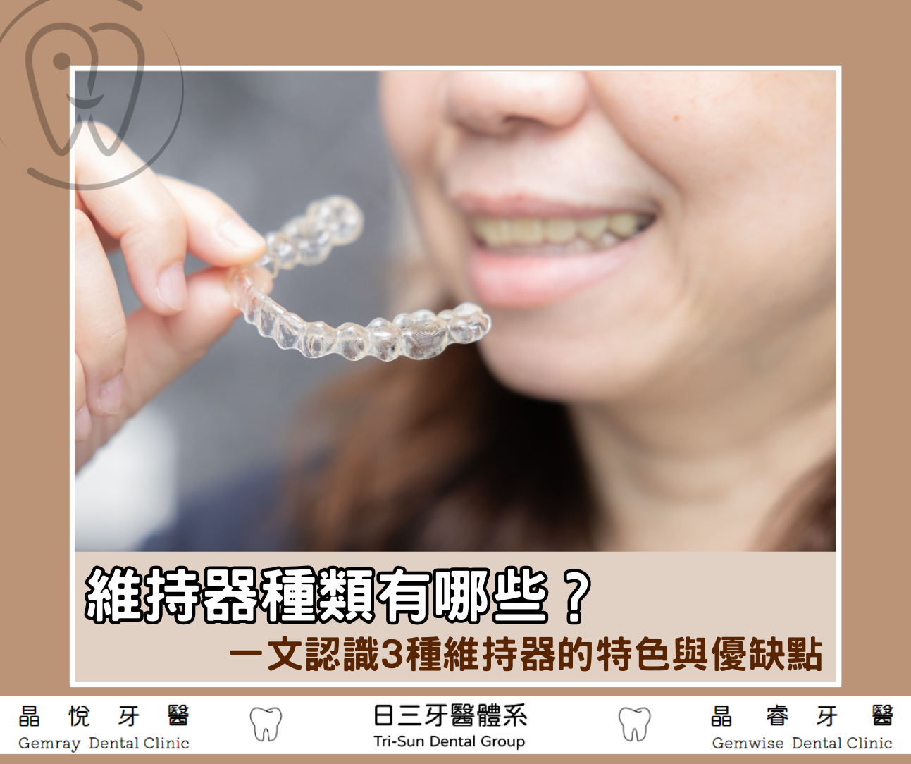 維持器種類有哪些？3大維持器配戴優缺點、適用對象總整理