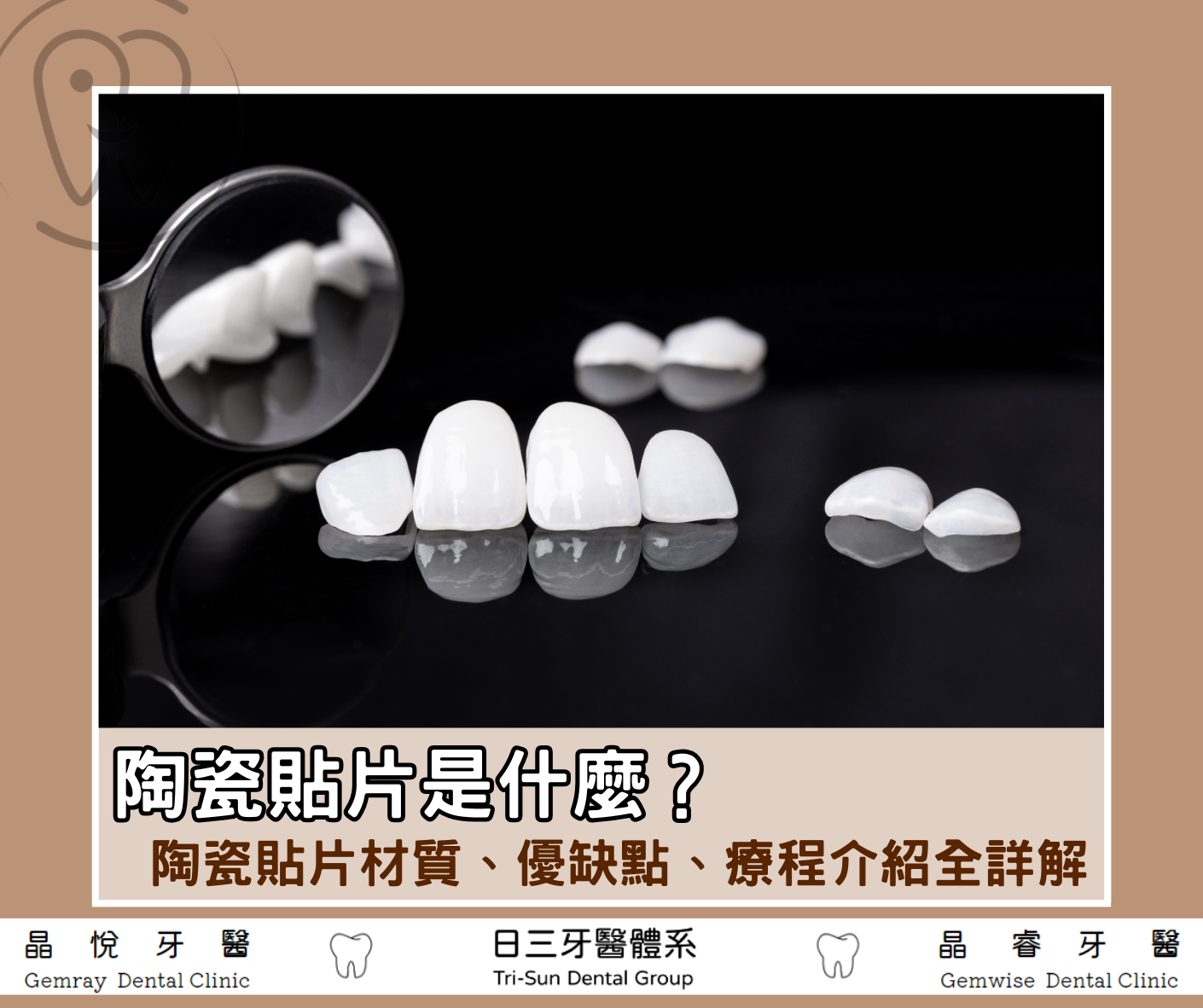 陶瓷貼片是什麼？陶瓷貼片材質、優缺點、療程介紹全詳解