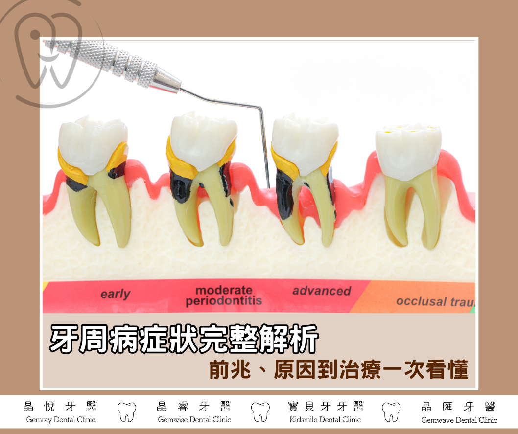 牙周病症狀完整解析：從前兆、原因到治療一次看懂
