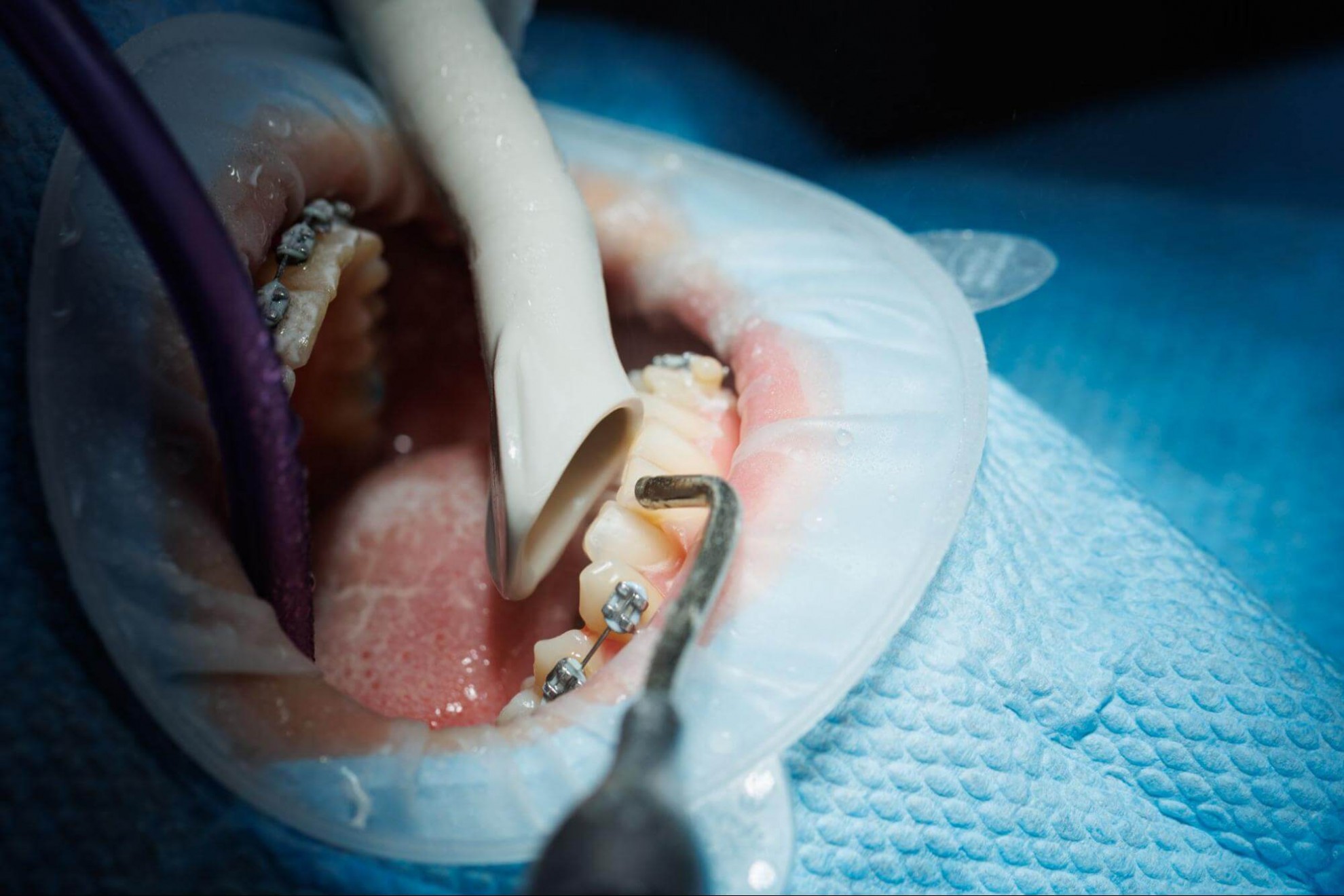 日三牙醫體系致力於提供全方位的植牙服務，整個植牙過程都有專業的醫師為您服務。