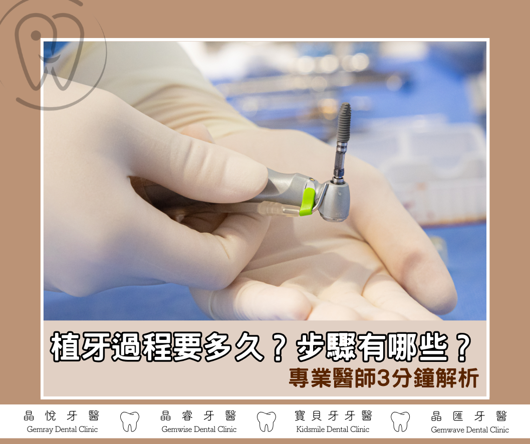 植牙過程要多久？植牙步驟有哪些？專業醫師3分鐘解析