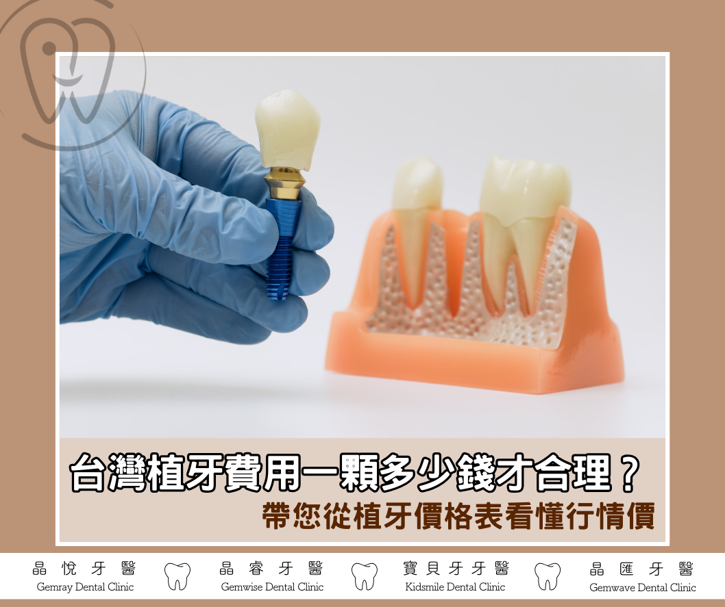 台灣植牙費用一顆多少錢才合理？帶您從植牙價格表看懂行情價