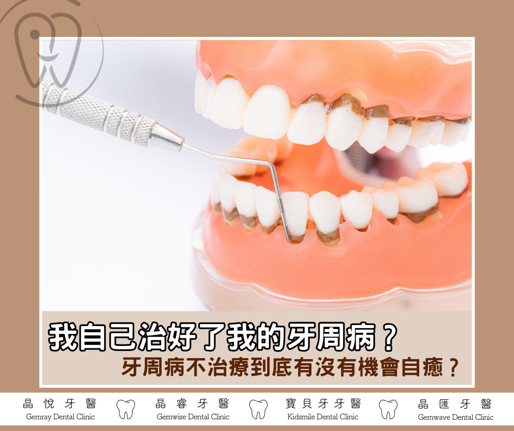 我自己治好了我的牙周病？牙周病不治療到底有沒有機會自癒？