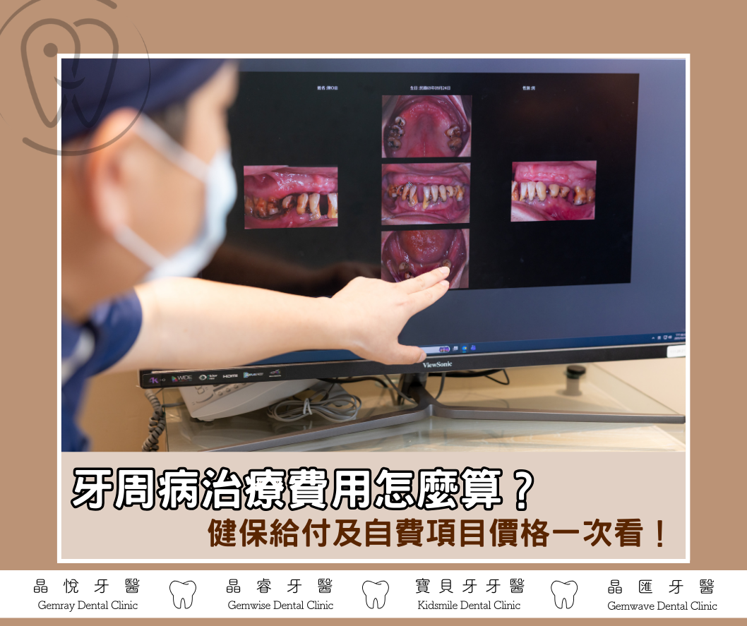 牙周病治療費用怎麼算？健保給付及自費項目價格一次看！