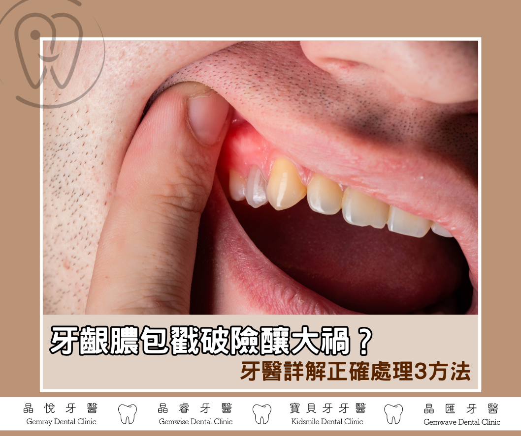 牙齦膿包戳破險釀大禍？會自己消嗎？牙醫詳解正確處理3方法