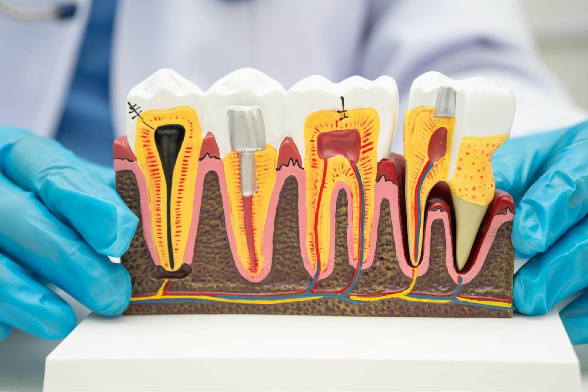 牙齦膿包戳破險釀大禍?會自己消嗎?牙醫詳解正確處理3方法 蛀牙、牙周病、外傷、感染造成牙齦長膿包