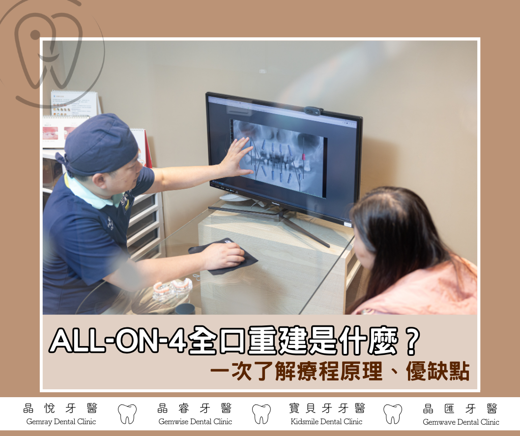 All-on-4全口重建是什麼？一次了解療程原理、優缺點