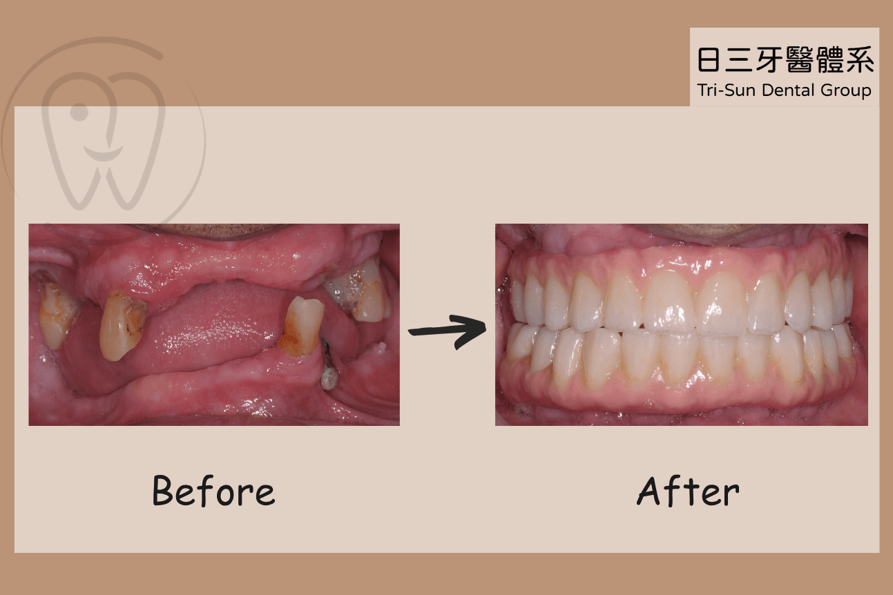 鄭伯伯 All on 4 治療案例