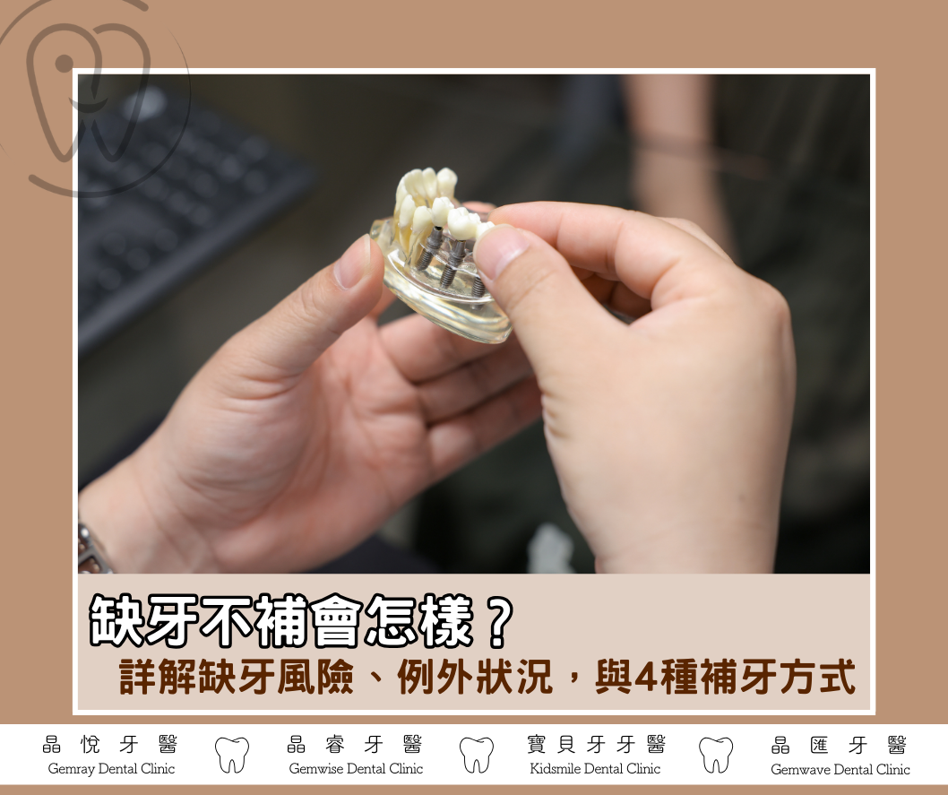 缺牙不補會怎樣？詳解缺牙風險、例外狀況，與 4 種補牙方式