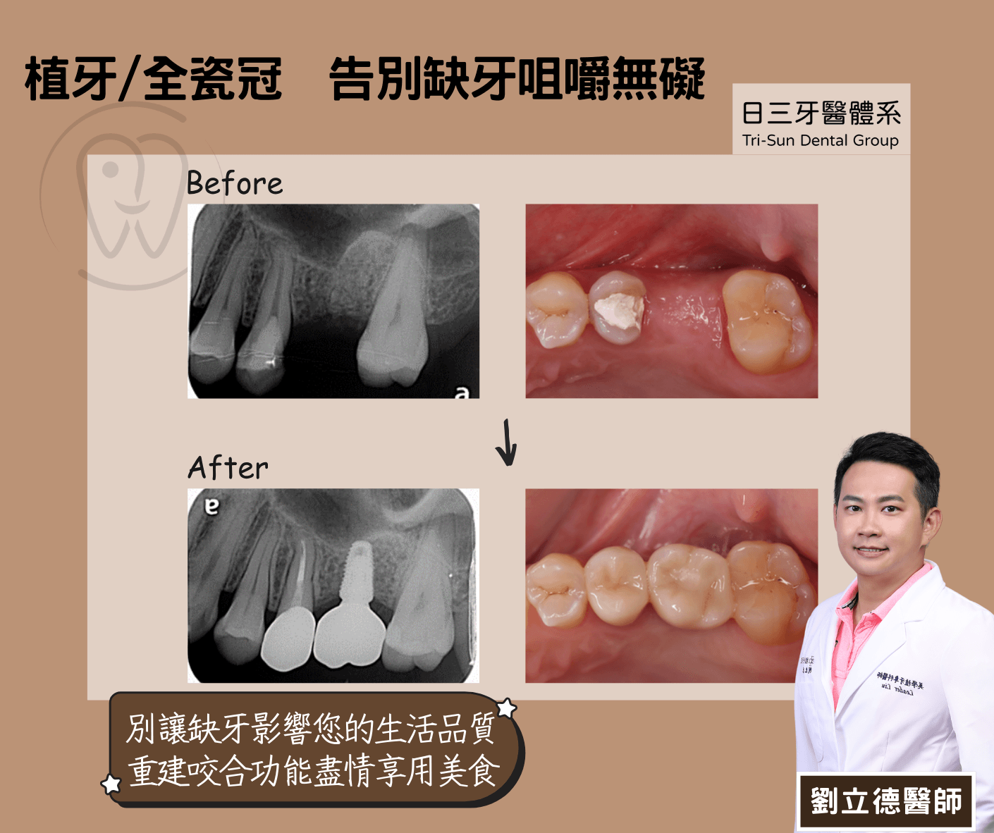 植牙與全瓷冠的缺牙修復方案