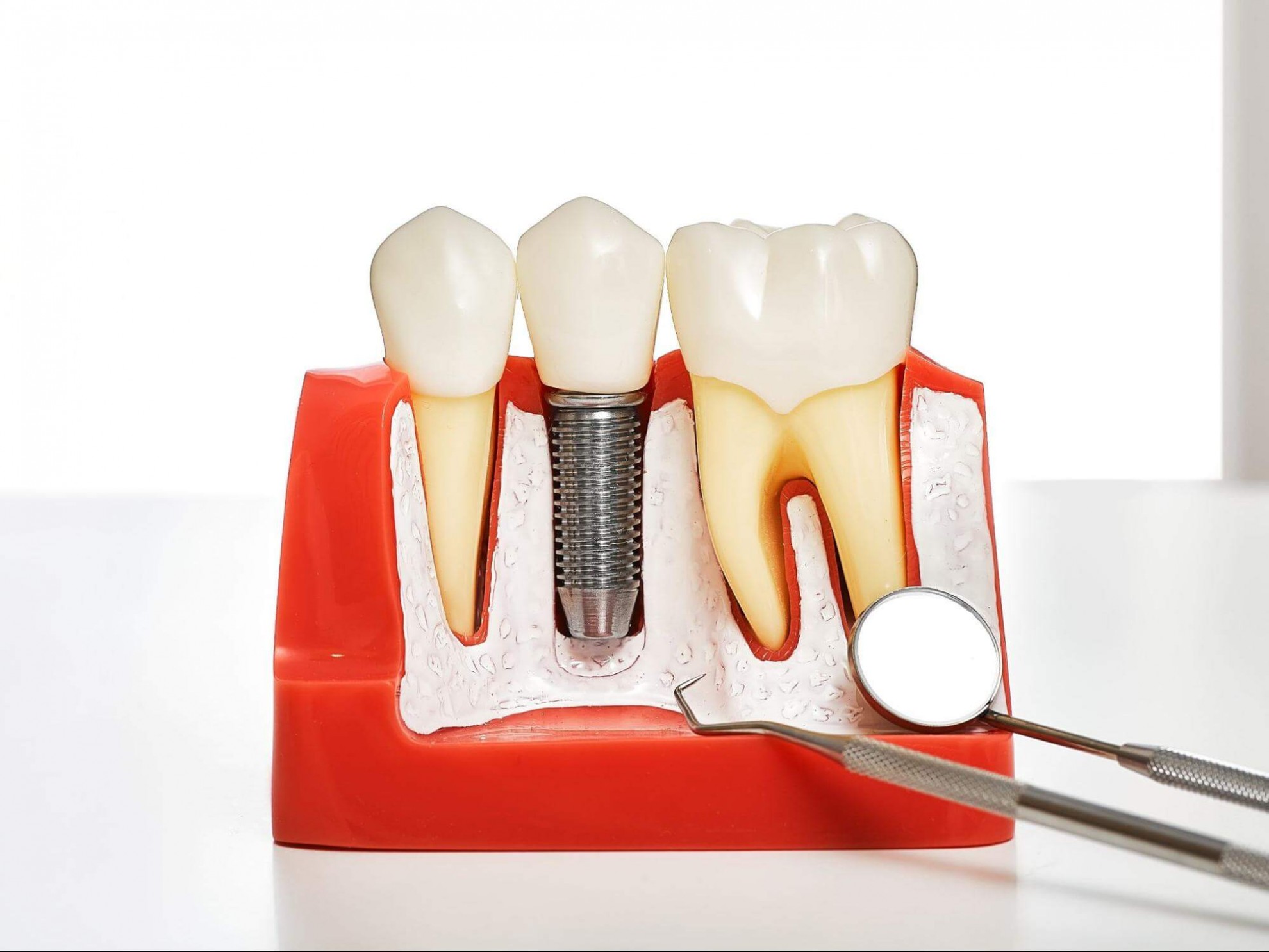 缺牙的治療方式說明