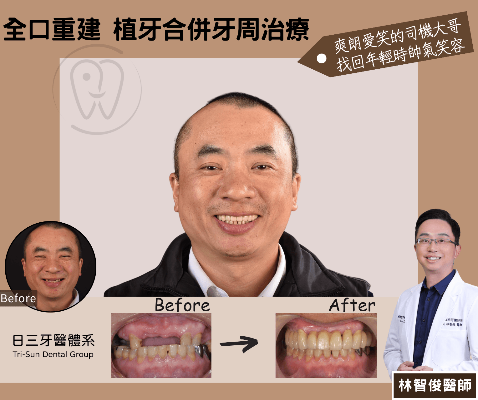 植牙與牙周病治療缺牙案例