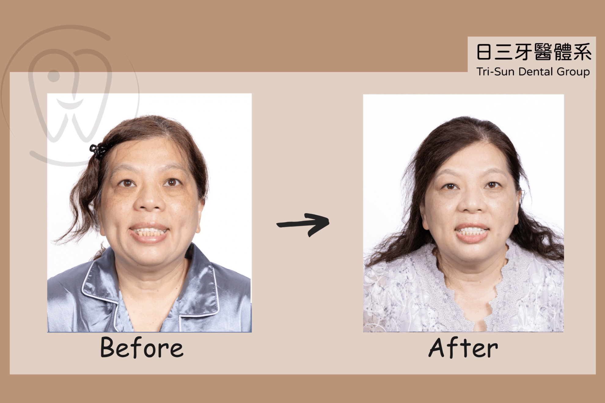 全口重建案例｜缺牙重建