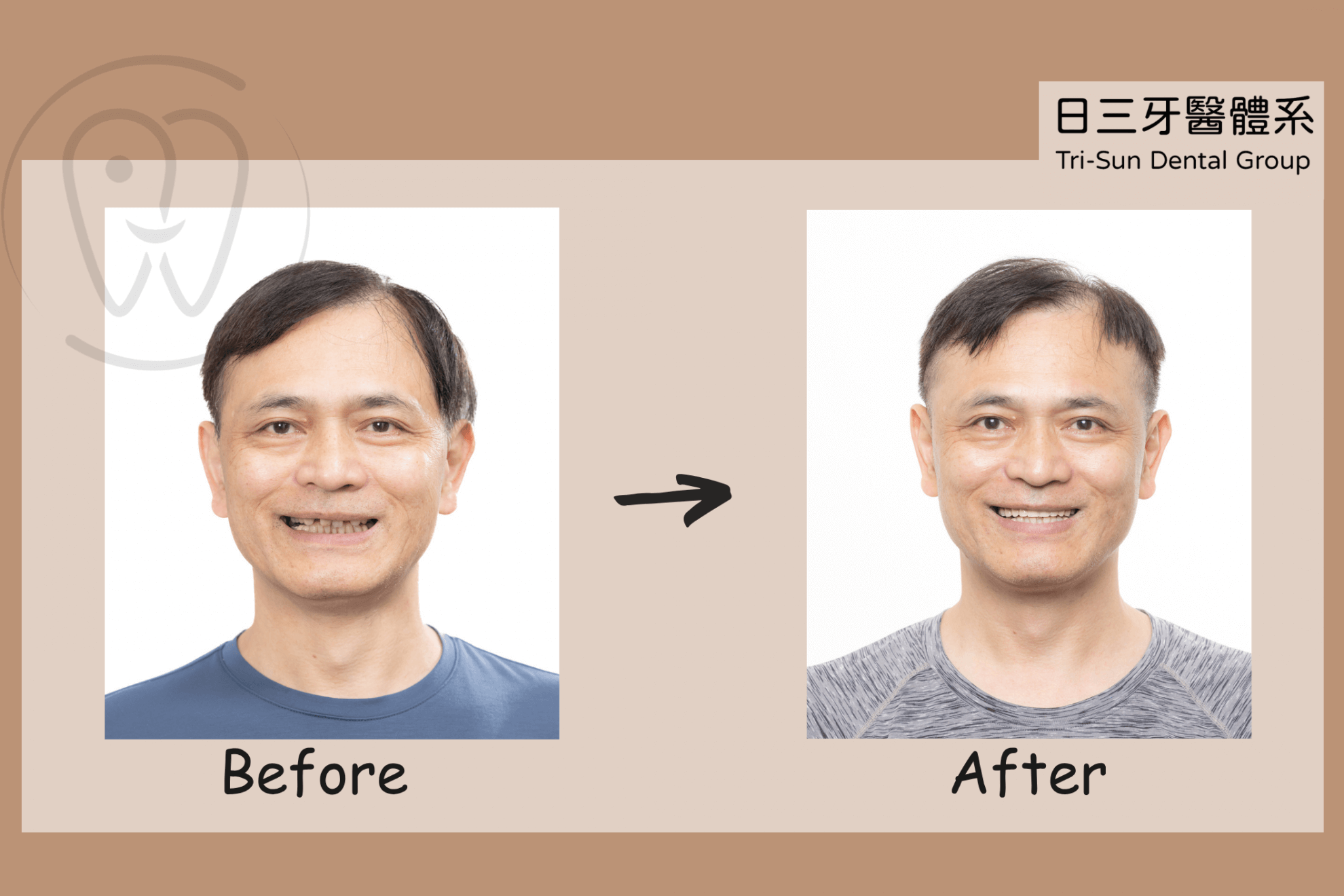 全口重建案例｜牙周病重建