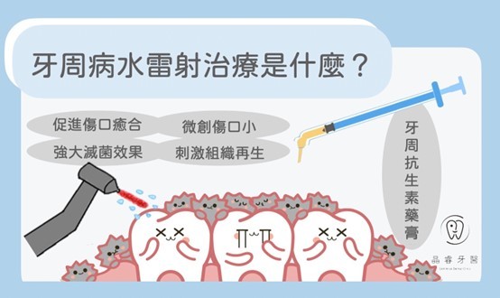 牙周病水雷射治療是什麼🤔 牙周病水雷射治療是什麼🤔