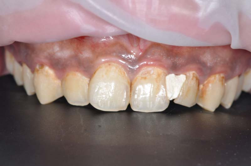 上門牙四顆「全瓷冠」