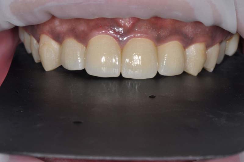 上門牙四顆「全瓷冠」