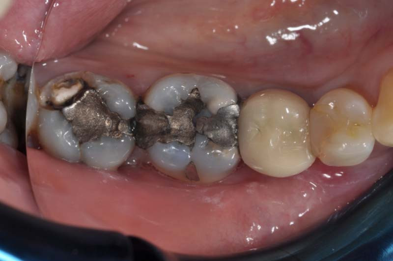 傳統銀粉更換成3D齒雕