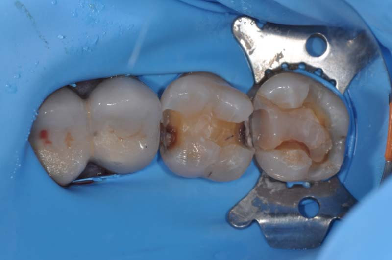 活髓治療+3D齒雕 - 3