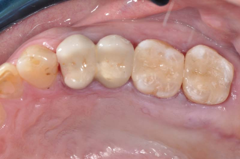 活髓治療+3D齒雕 - 3