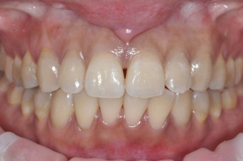 上門牙兩顆「輕透瓷貼片」