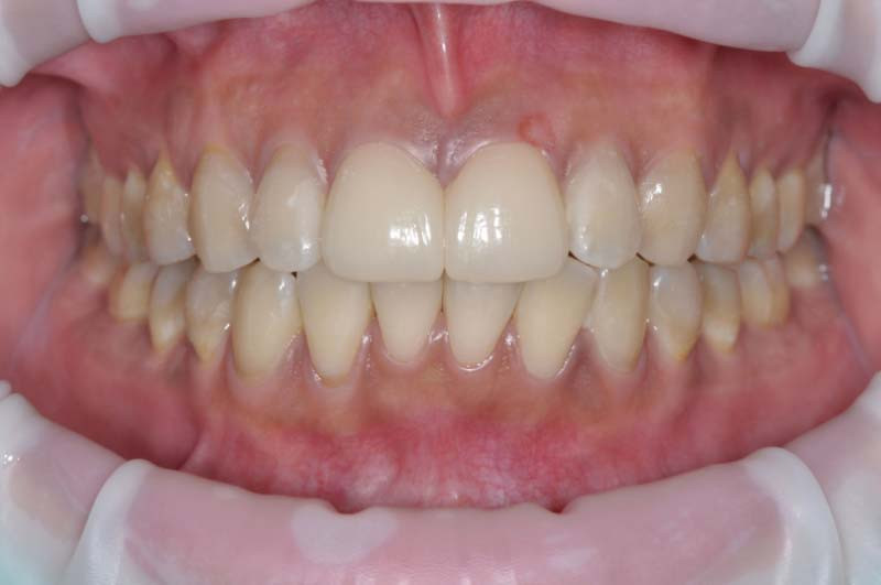 上門牙兩顆「輕透瓷貼片」