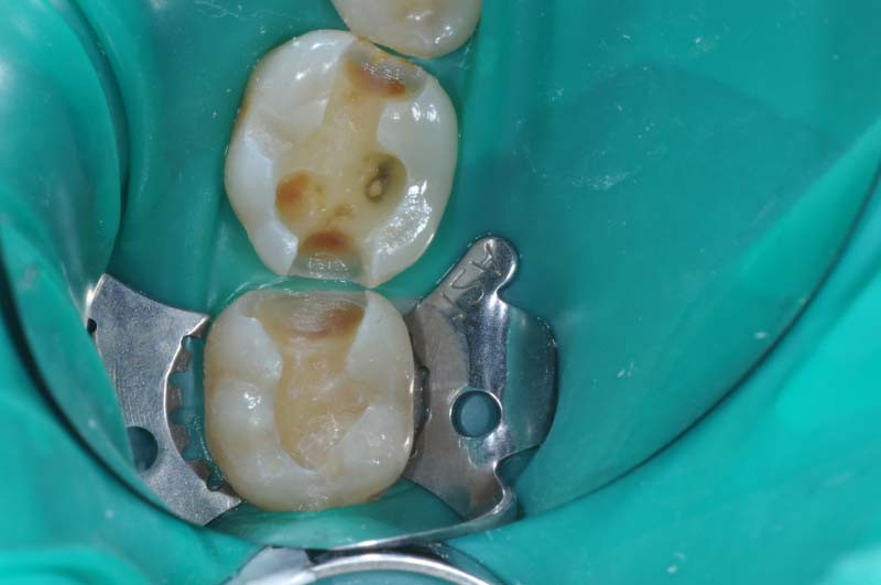 活髓治療+3D齒雕 - 2