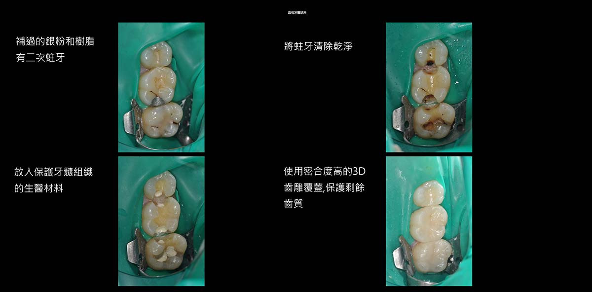 活髓治療+3D齒雕 - 1