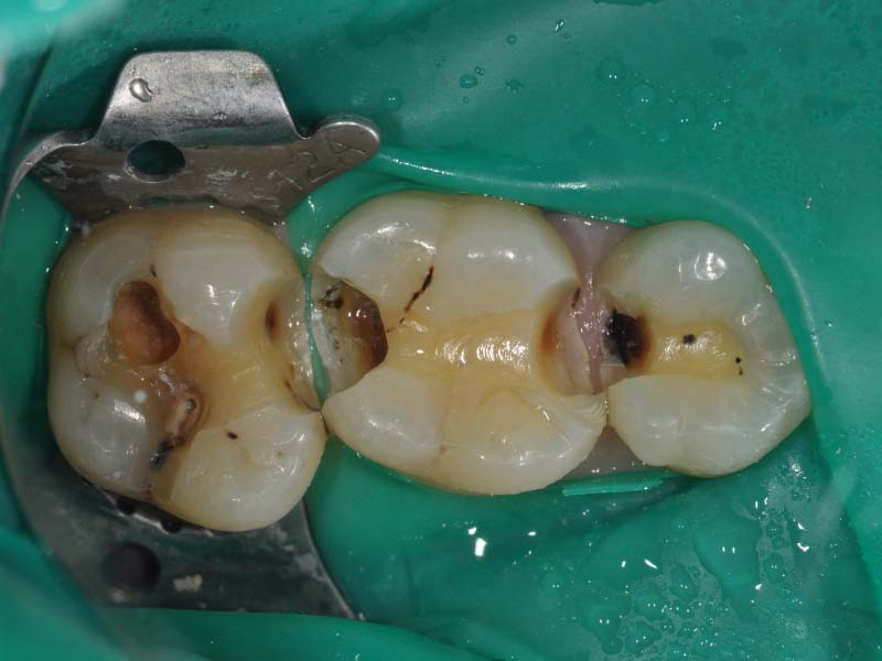 活髓治療+3D齒雕 - 1