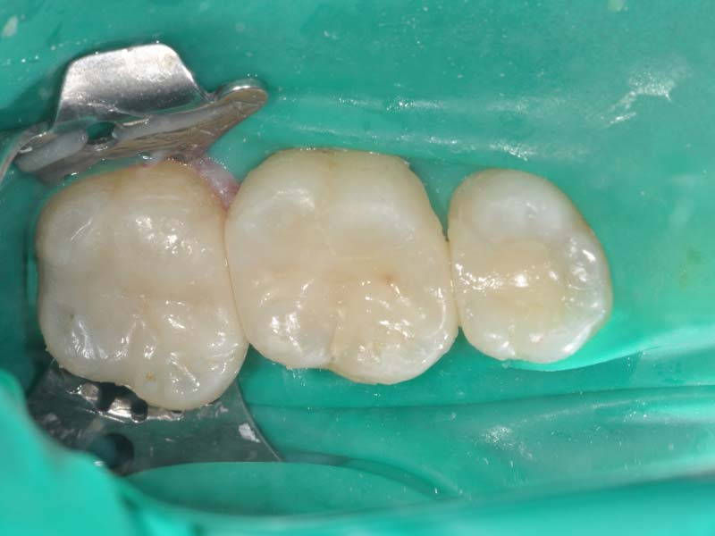 活髓治療+3D齒雕 - 1