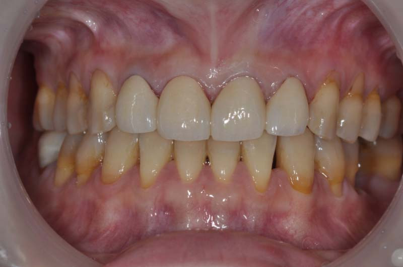 上門牙四顆「全瓷冠」