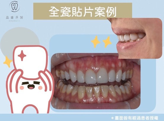 全瓷貼片 全瓷貼片