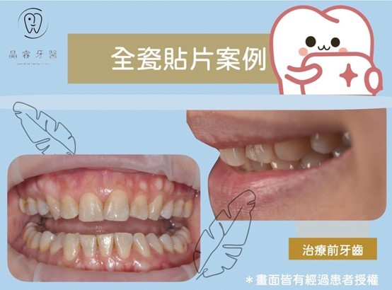 全瓷貼片 全瓷貼片
