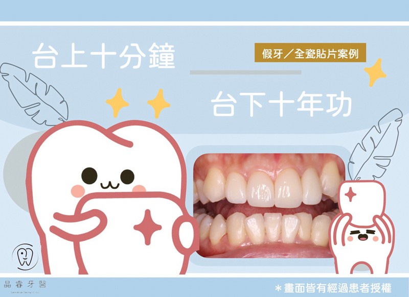全瓷貼片+假牙 全瓷貼片+假牙