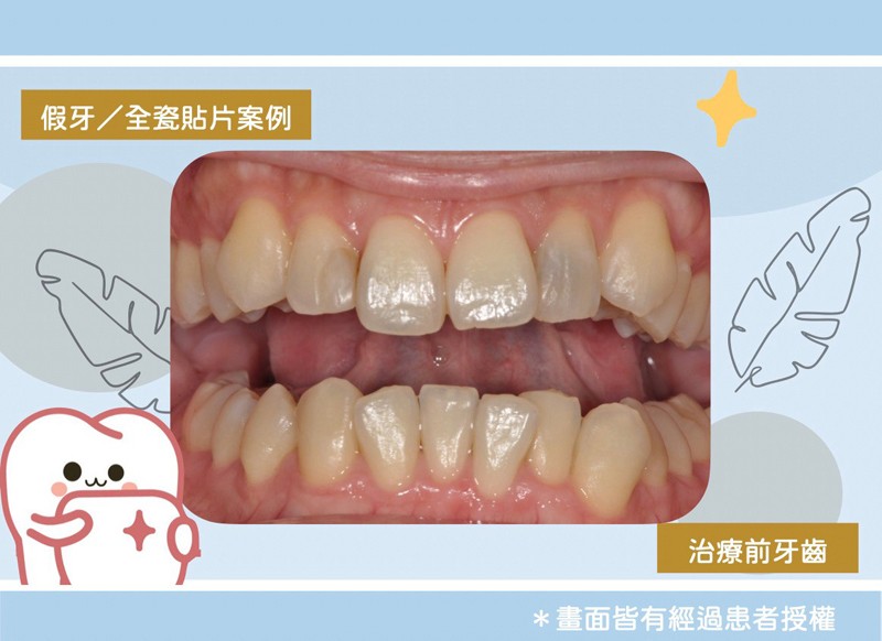 全瓷貼片+假牙 全瓷貼片+假牙