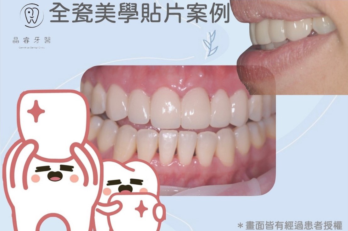全瓷美學貼片 全瓷美學貼片