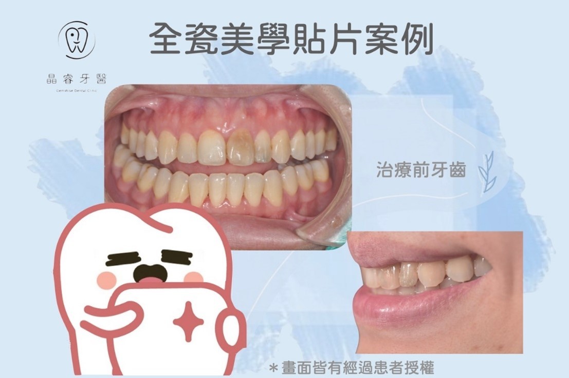 全瓷美學貼片 全瓷美學貼片