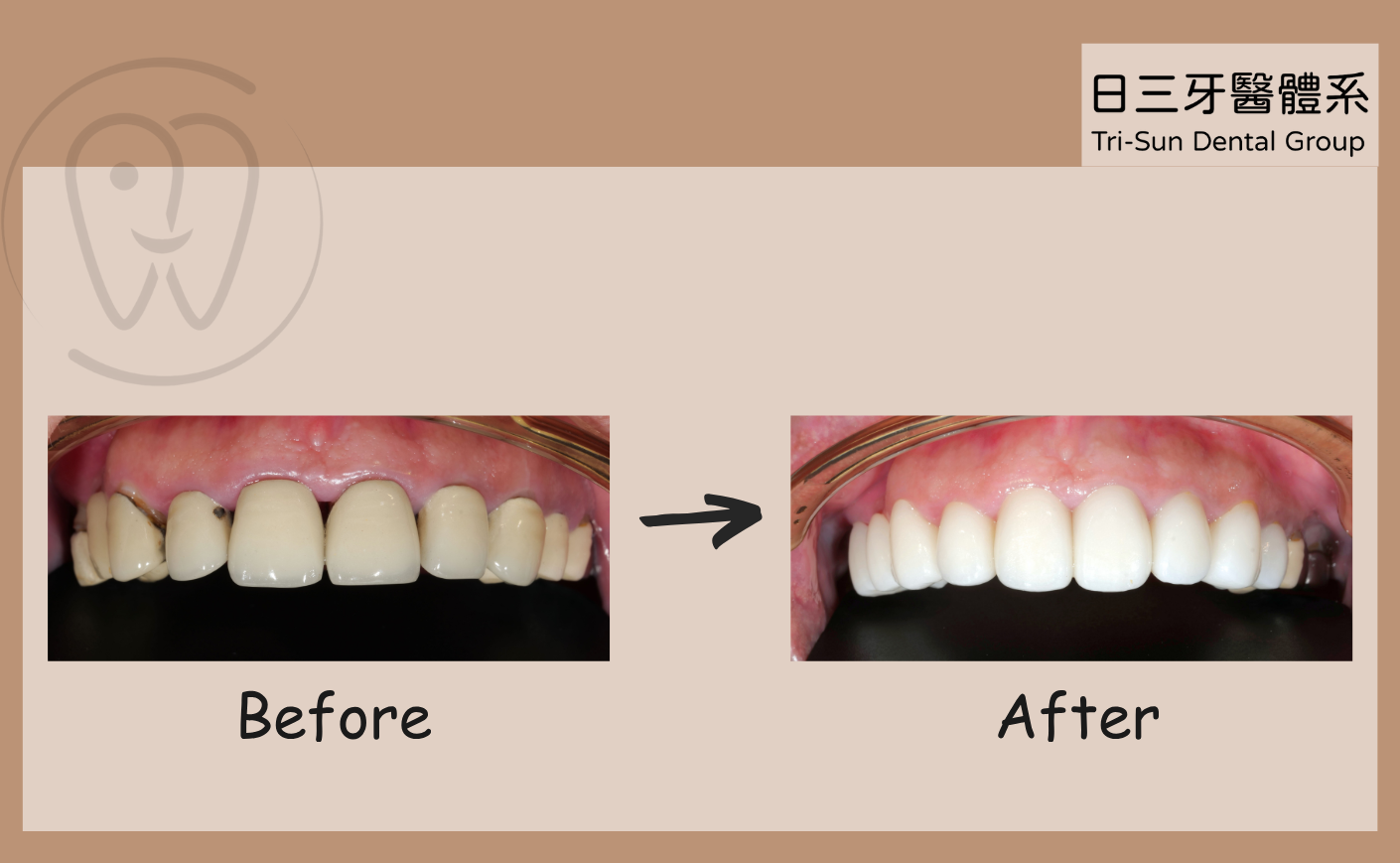 擺脫舊金屬瓷牙的陰影 擺脫舊金屬瓷牙的陰影