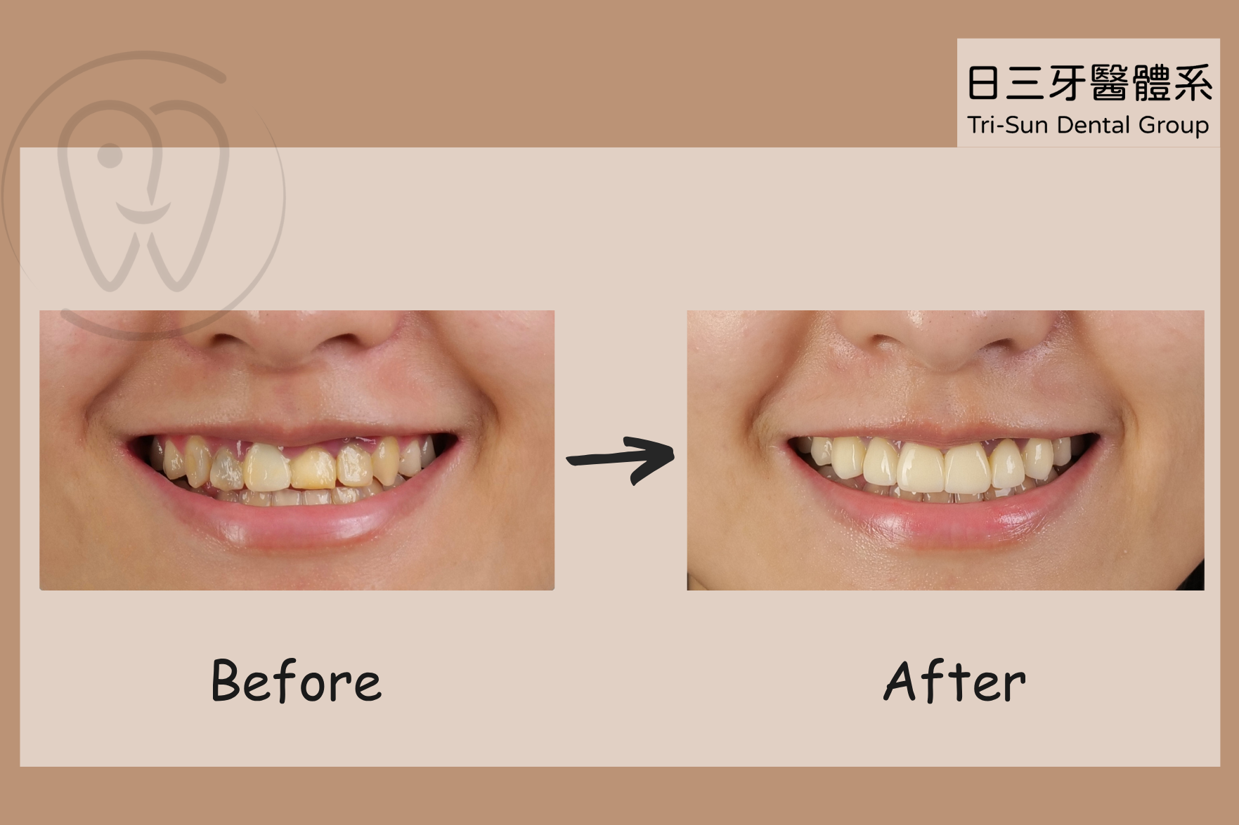 矯正搭配全瓷冠讓笑容完美升級 矯正搭配全瓷冠讓笑容完美升級