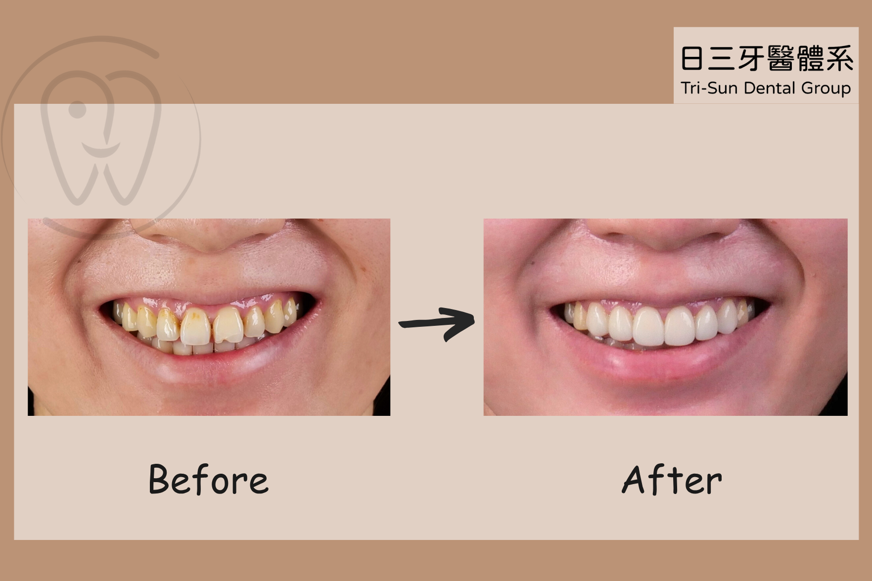 貼片解決長久缺角和牙縫困擾 貼片解決長久缺角和牙縫困擾
