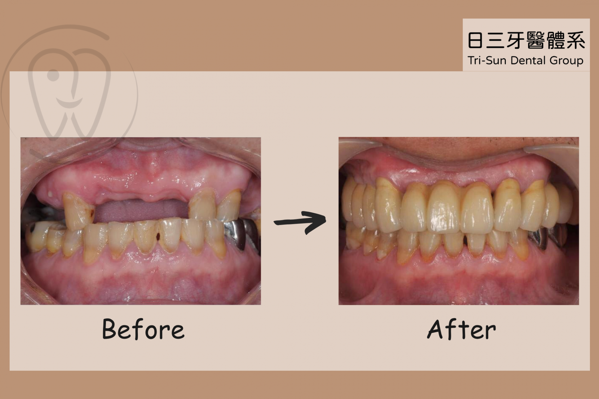 完美重現年輕的自信笑容 完美重現年輕的自信笑容