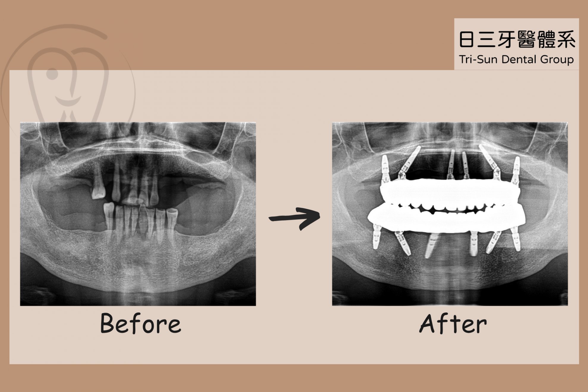 重建牙齒後 整體看起來年輕十歲 重建牙齒後 整體看起來年輕十歲