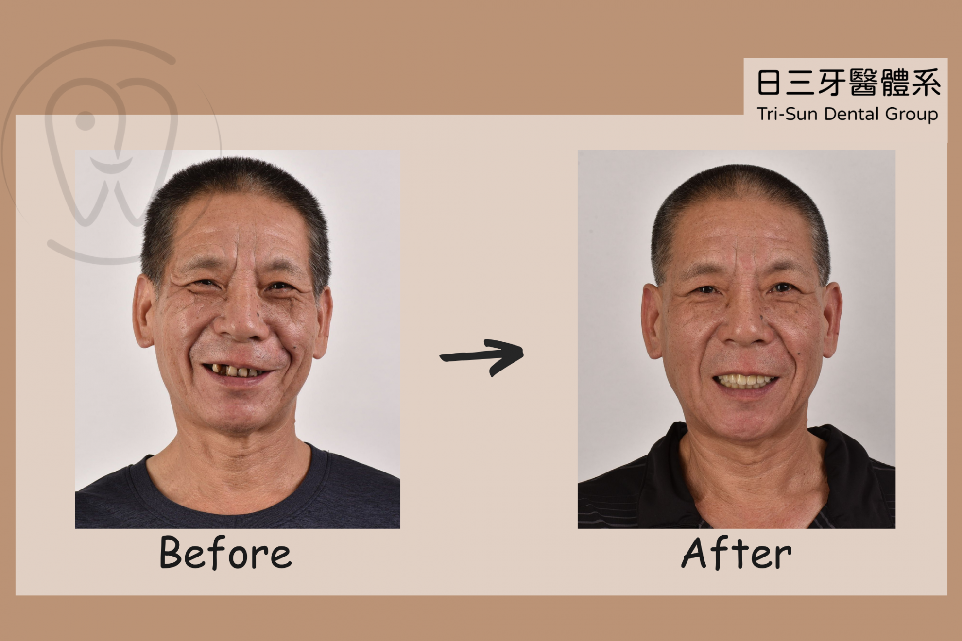 重建牙齒後 整體看起來年輕十歲 重建牙齒後 整體看起來年輕十歲