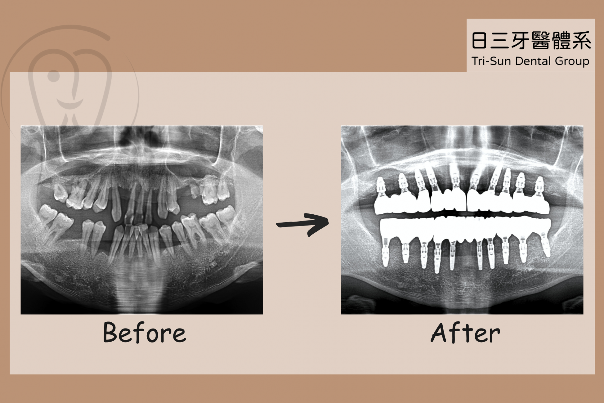 全口植牙也可以當天就有牙 全口植牙也可以當天就有牙