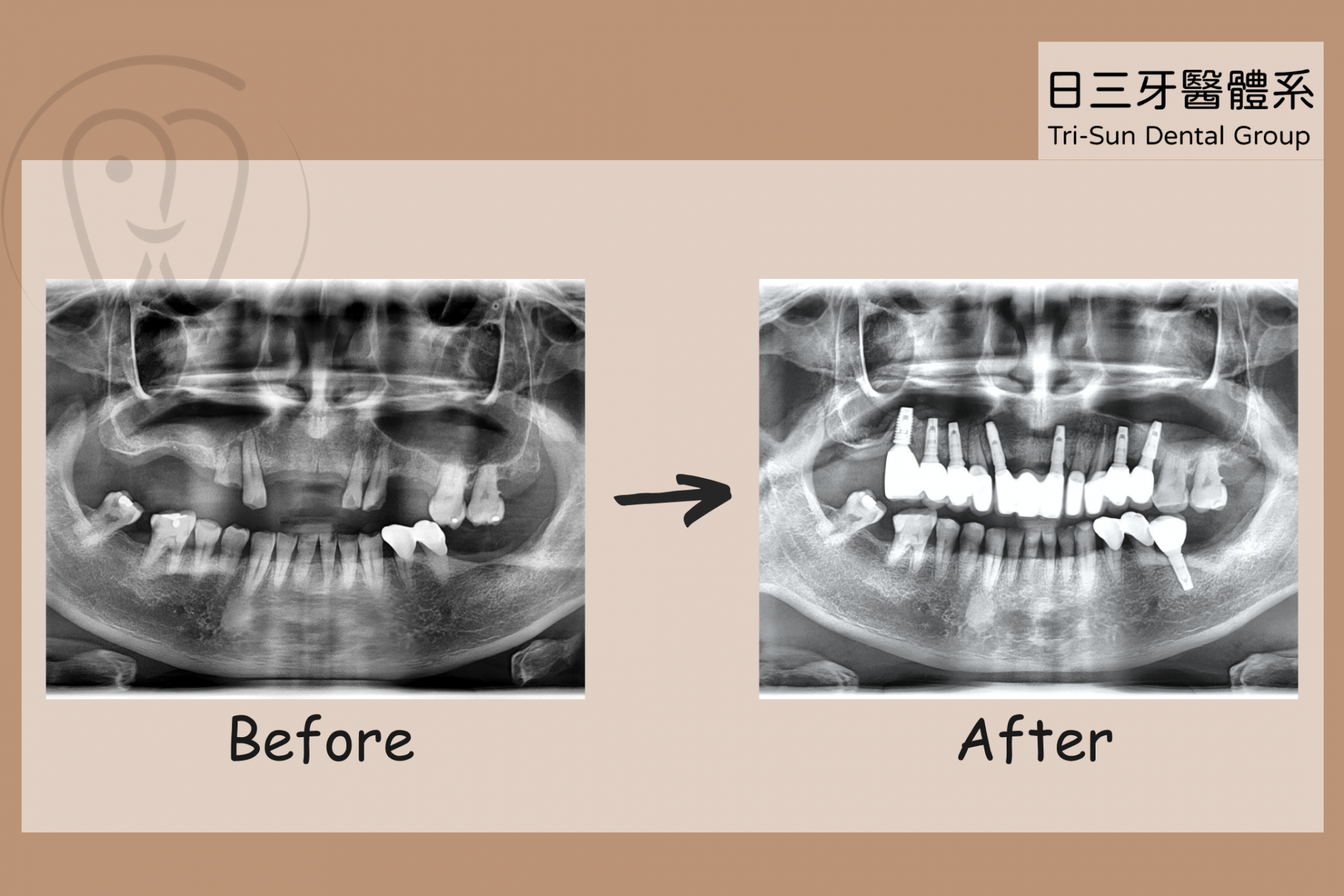 完美重現年輕的自信笑容 完美重現年輕的自信笑容