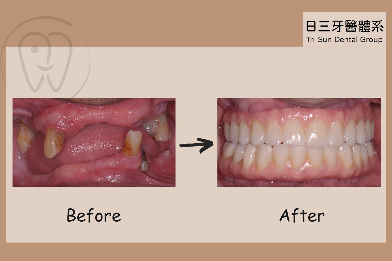 告別活動假牙 重建穩固牙齒 告別活動假牙 重建穩固牙齒