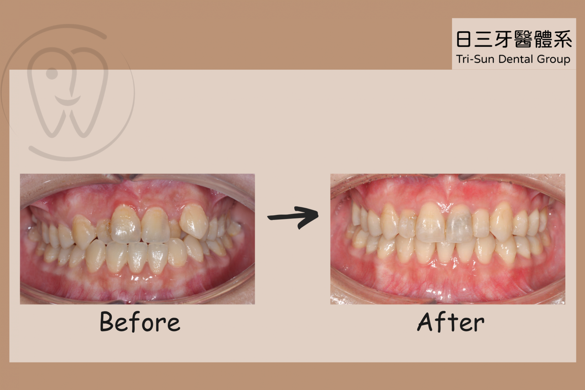解決錯咬牙周困擾 呈現完美笑容 解決錯咬牙周困擾 呈現完美笑容